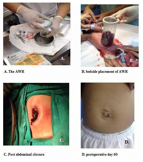 Animals | Free Full-Text | Double-Wound O-Ring Retraction for Chylothorax  Surgery in Dogs